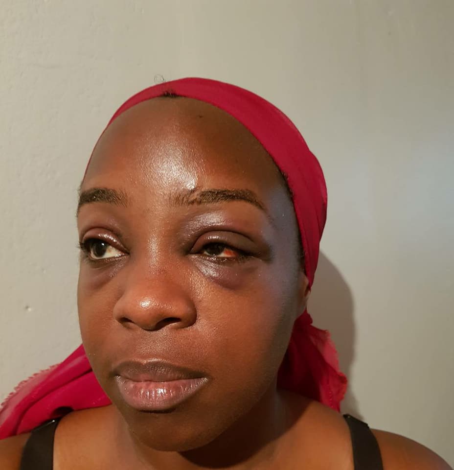 Beaten; Angella Katatumba with a swollen eye